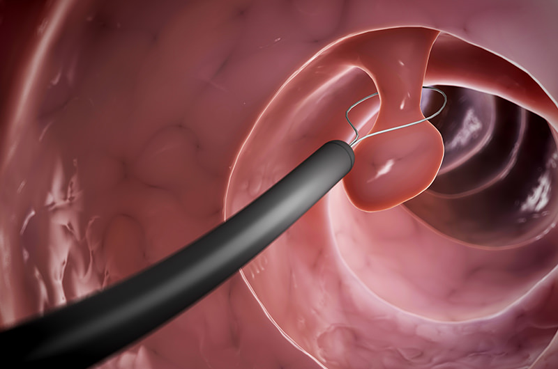 内視鏡下でポリープ切除が可能